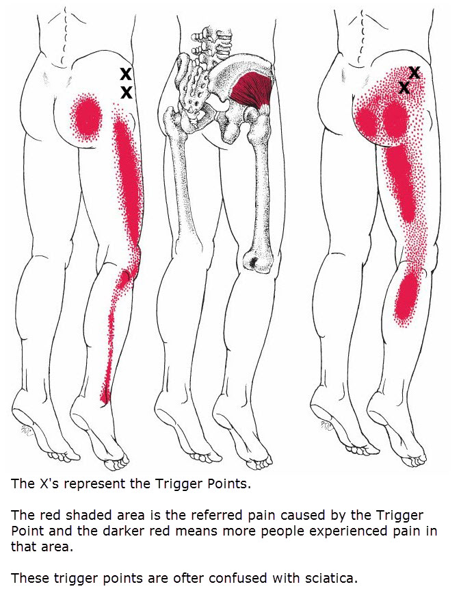 Trigger Point chart
